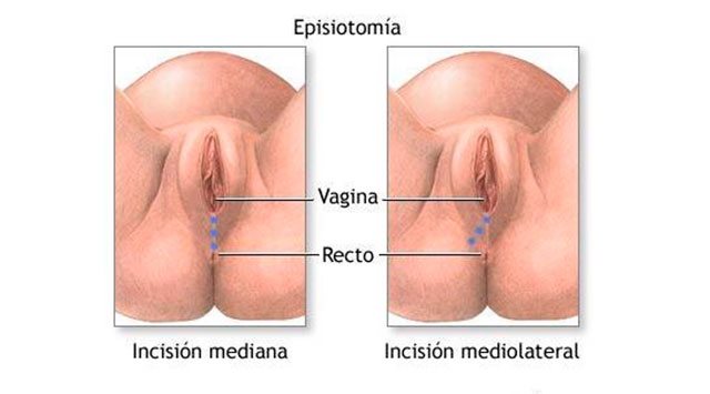 Episiotomía