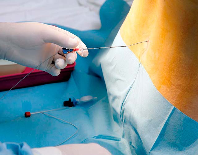 anestesia epidural