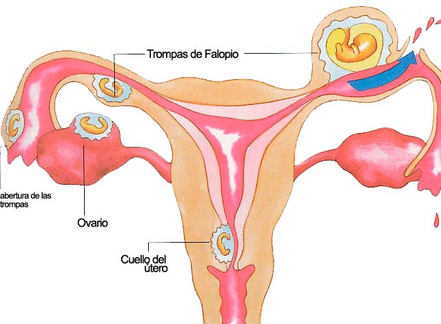 Embarazo ectópico o extrauterino