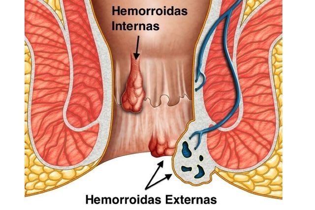Hemorroides y embarazo