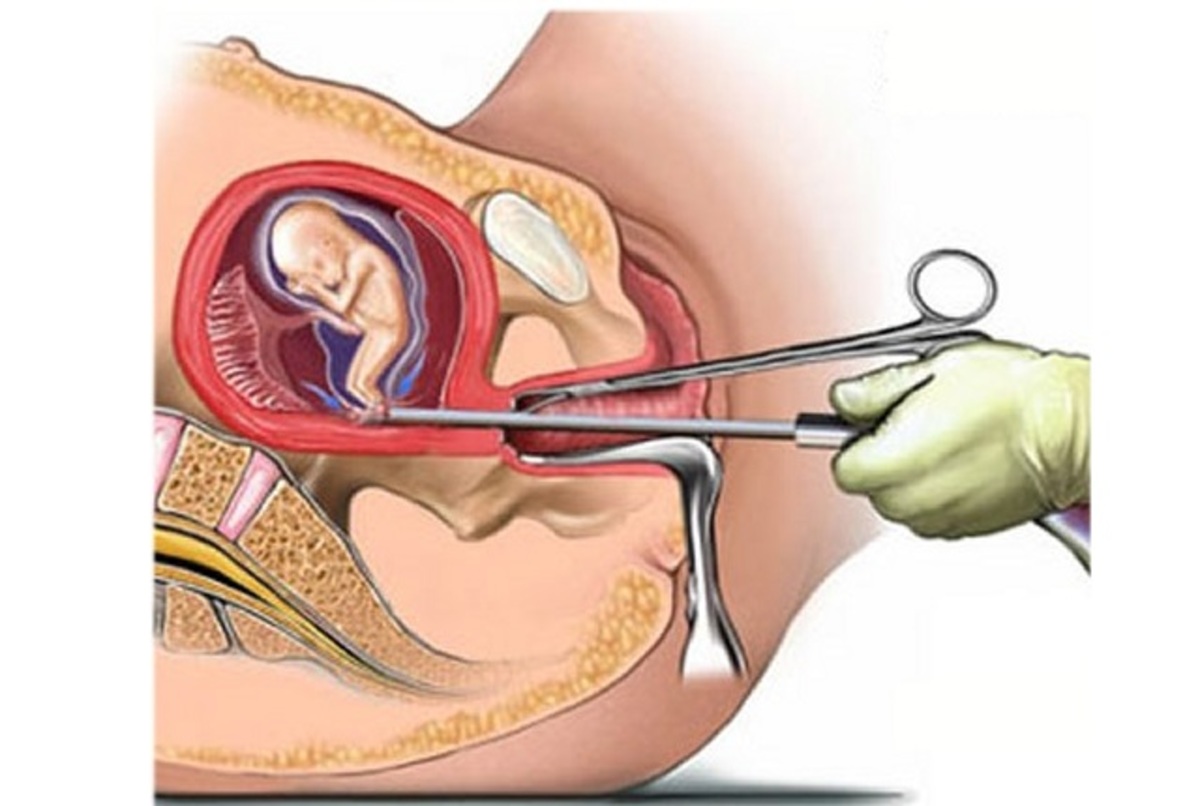 Диагностическое выскабливание матки и цервикального канала