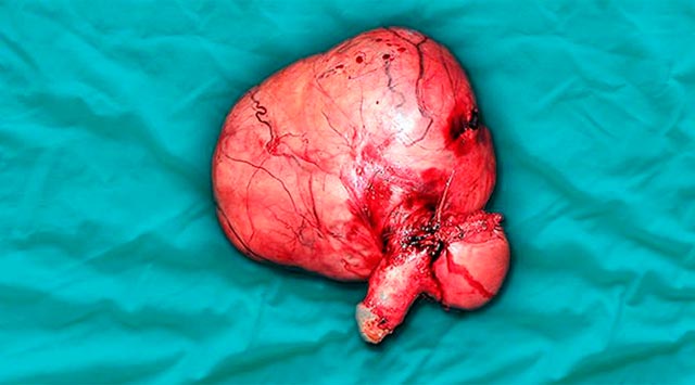 fibroma uterino