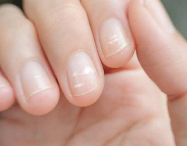 Leuconiquia manchas blancas en las uñas