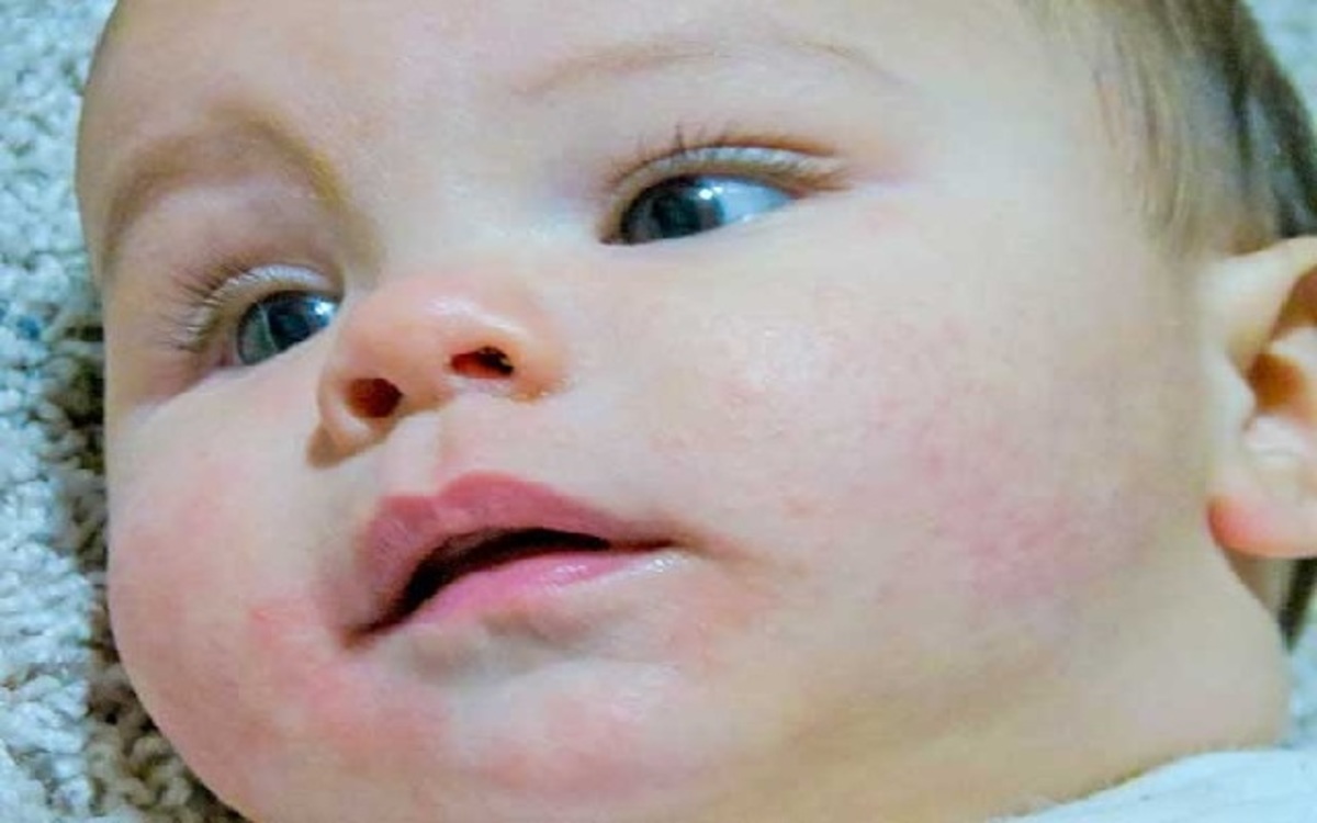 Sarpullido En Bebés ¿a Que Se Debe