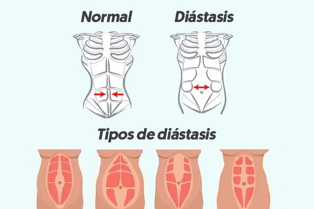 diástasis-abdominal-tipos-de-diastasis