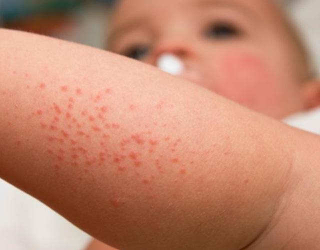 Los eczemas en niños: qué son y cómo tratarlos