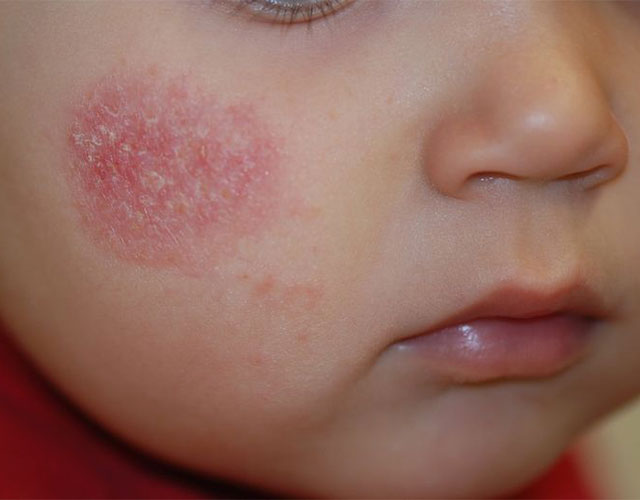 Eczema en la cara del bebé
