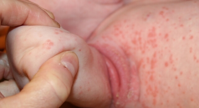 Los eczemas en niños