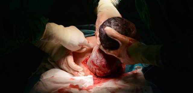 cicatriz por la cesárea