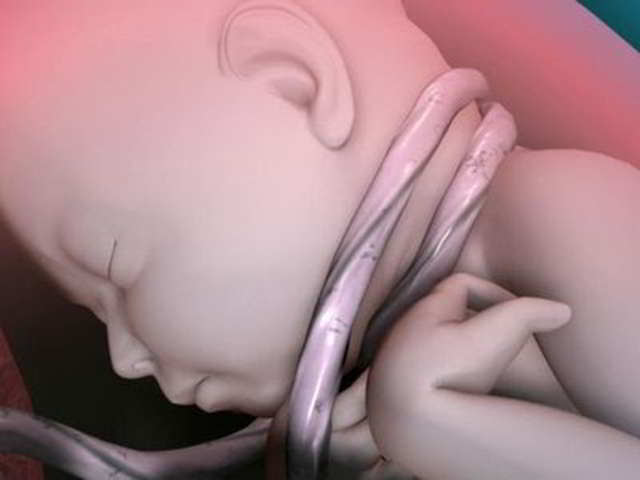 cordón umbilical en el cuello del bebé