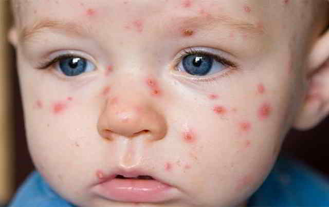 síntomas de la varicela
