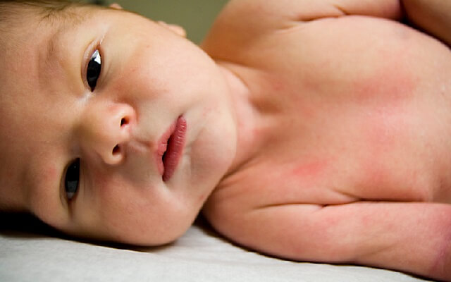 Efectos secundarios de vacunas en bebés
