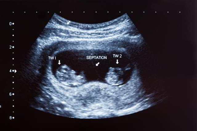 ecografia de embarazo de gemelos