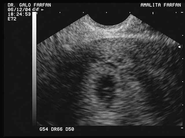 embrión humano visto por ultrasonido