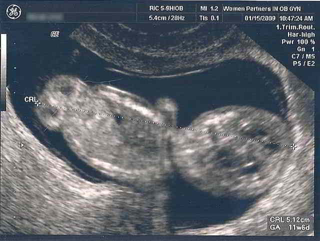 ver embrión por ultrasonido