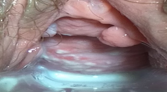Candidiasis vaginal durante el embarazo