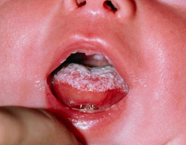 hongos en la boca en bebés
