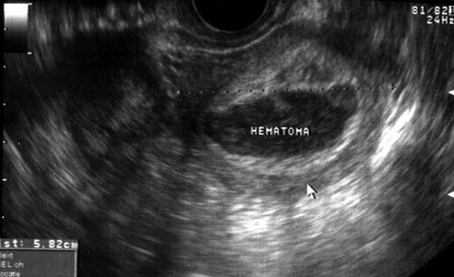 Hematoma en la placenta