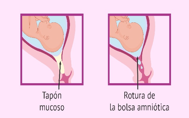 tapón mucoso