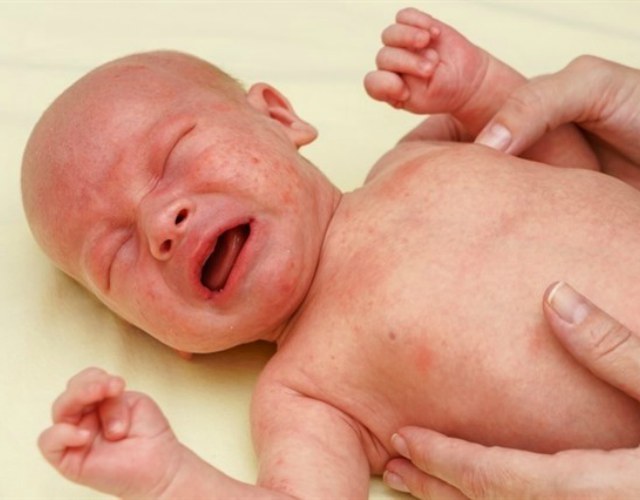 Sarpullidos por calor en bebés