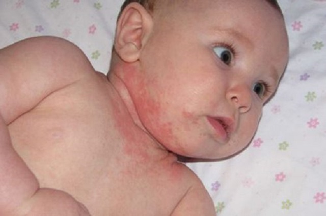 Dermatitis bebés
