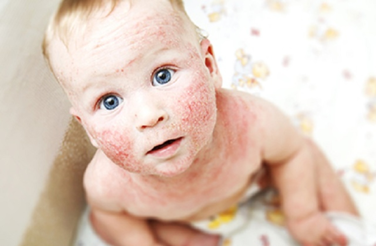 Dermatitis atópica en bebés