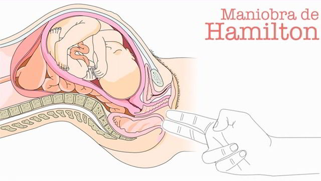 maniobra de hamilton en embarazadas