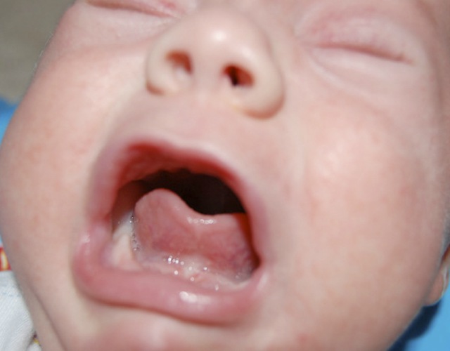 Anquiloglosia en bebés