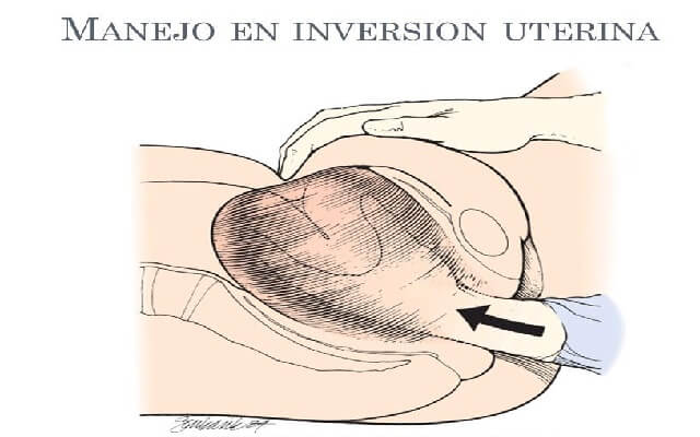 Inversión uterina
