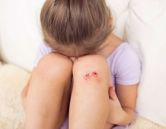 cómo evitar la infección de heridas en niños