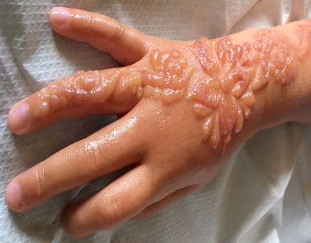 los riesgos de los tatuajes de henna para niños