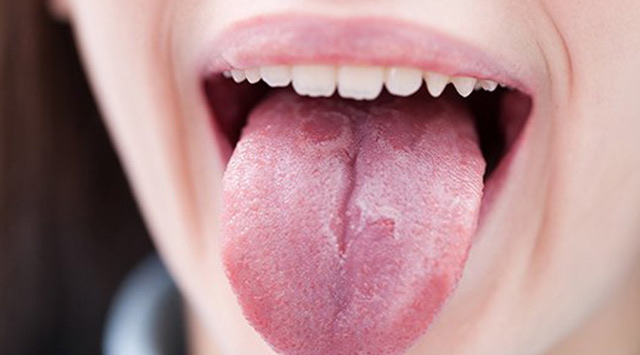 ¿Qué es la candidiasis oral?