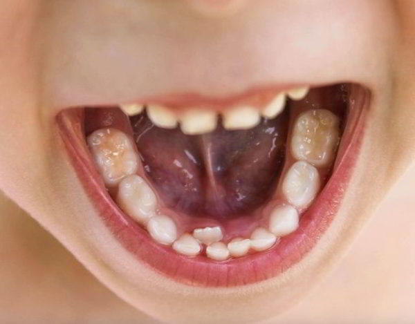 por que a los niños les sale una segunda fila de dientes