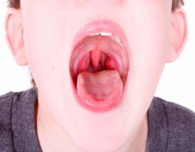 Nódulos en las cuerdas vocales de niños