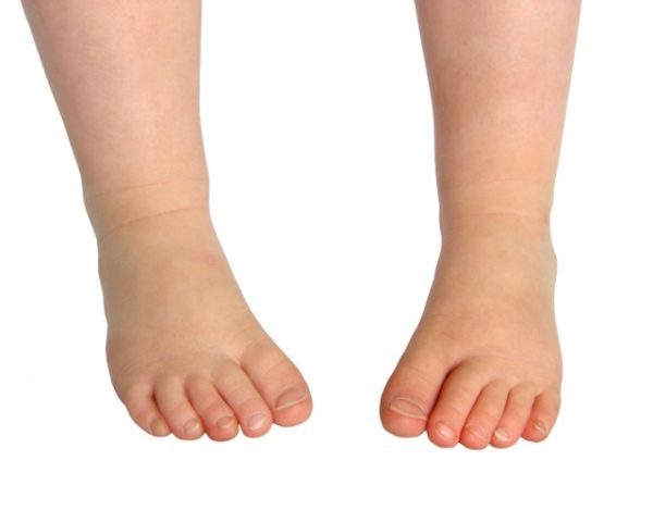 Anomalías congénitas en piernas y pies