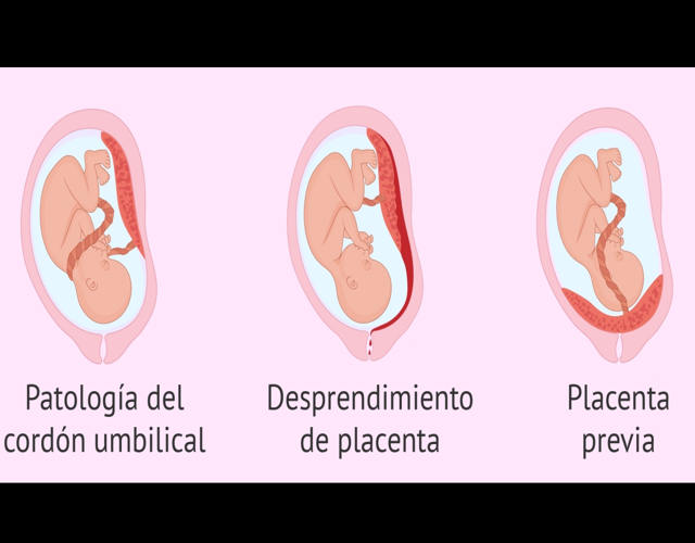 Causas placentarias muerte fetal