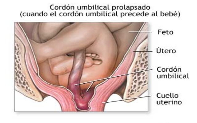 Complicaciones del cordón umbilical en el embarazo