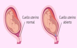 Cuello del Útero Incompetente y cómo se trata