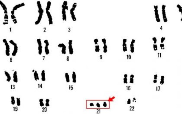 anomalías cromosómicas