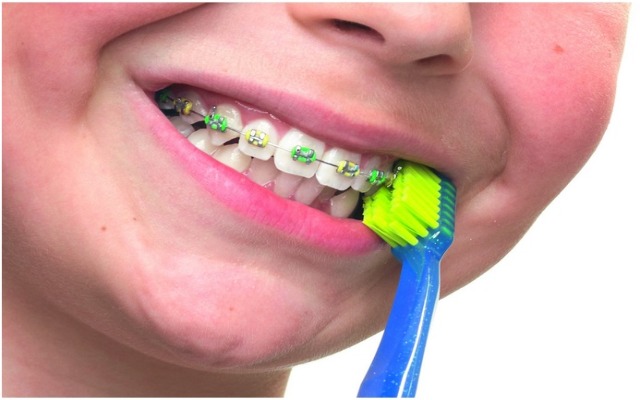 los dientes de los niños con brackets